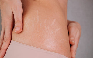 Does Castor Oil Help Stretch Marks? Benefits & How to Use It