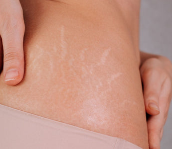 Does Castor Oil Help Stretch Marks? Benefits & How to Use It