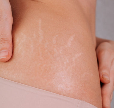 Does Castor Oil Help Stretch Marks? Benefits & How to Use It