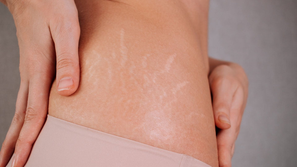 Does Castor Oil Help Stretch Marks? Benefits & How to Use It
