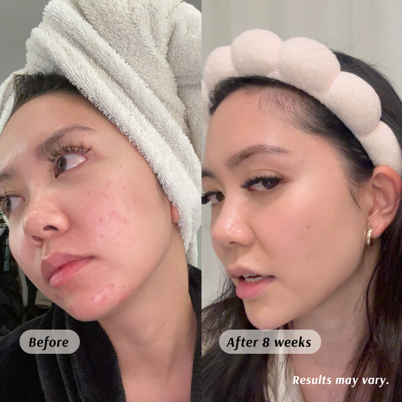 Before and after comparison of a woman's face with text indicating results may vary.