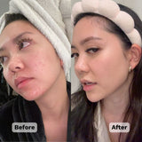 Before and after picture of a woman that had blemishes 