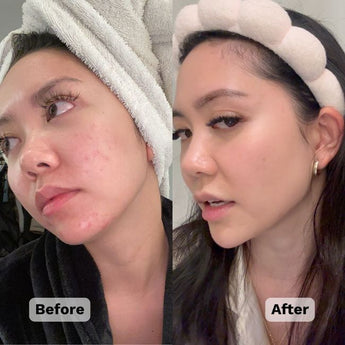 Before and after picture of a woman that had blemishes 